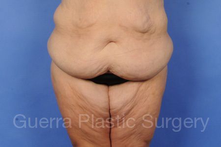 next Case #21587 Before