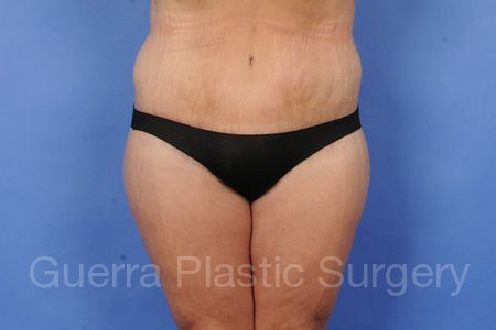 next Case #21587 After