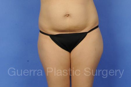 Before Photo Tummy Tuck