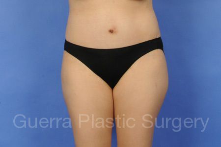 After Photo Tummy Tuck