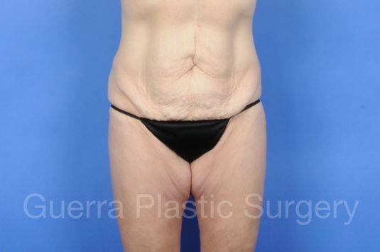 next Case #01255 Before