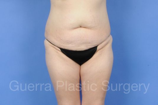 next Case #01272 Before