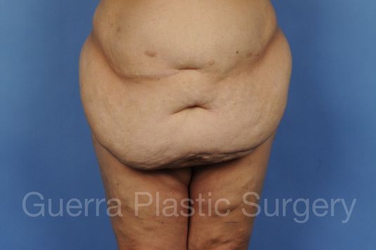 next Case #01274 Before