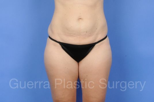 next Case #01275 Before