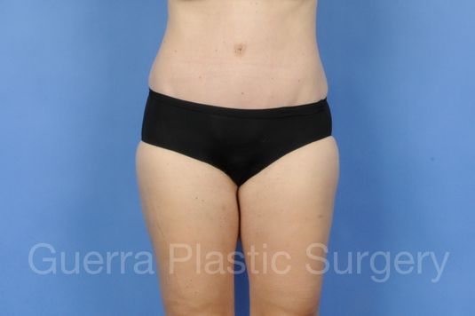 next Case #01275 After