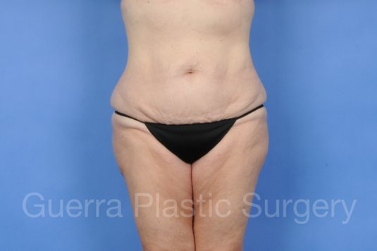 next Case #01277 Before