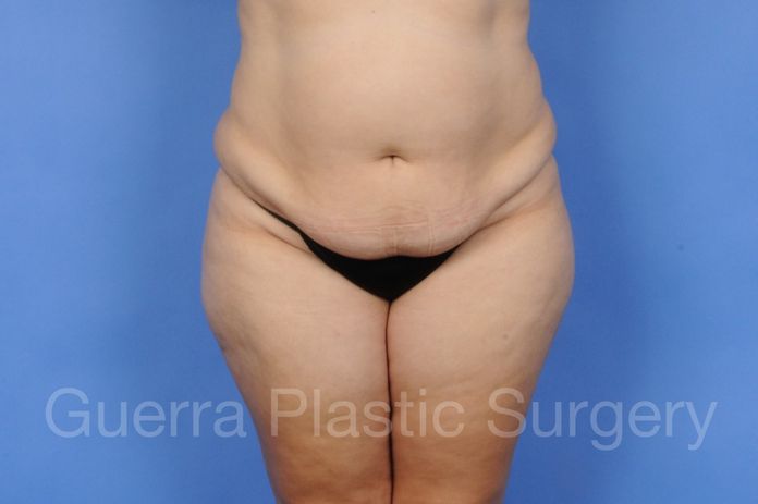 Tummy Tuck Case #01286 - before