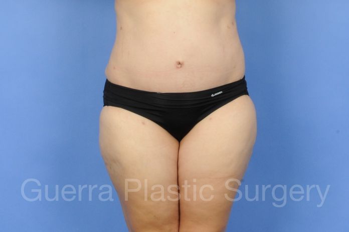 Tummy Tuck Case #01286 - after
