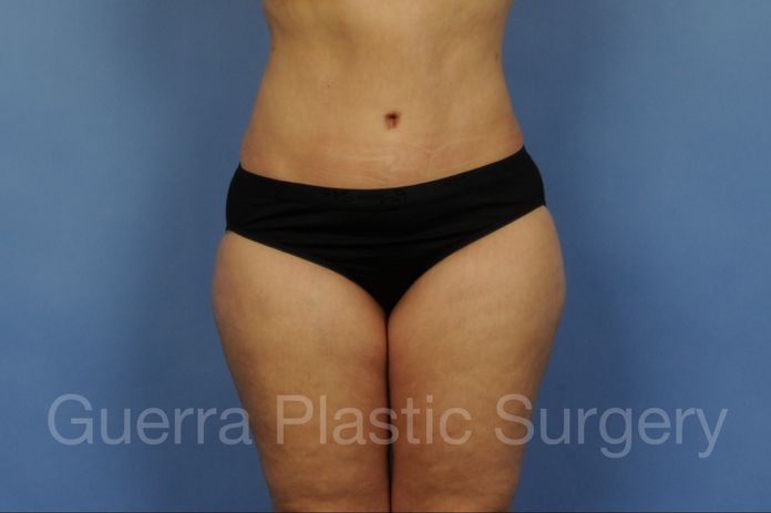 Tummy Tuck Case #3013 - after