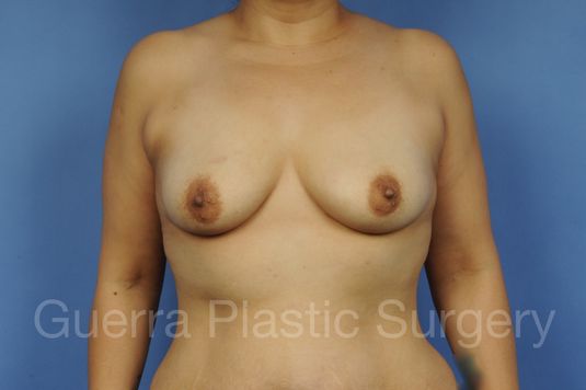 Case #1101022 Before