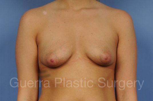 Case #1101024 Before