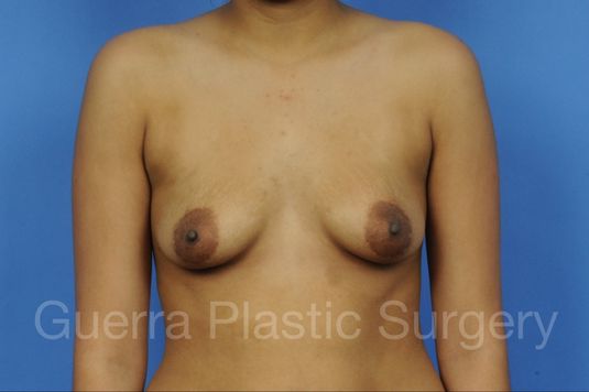 Case #1101011 Before