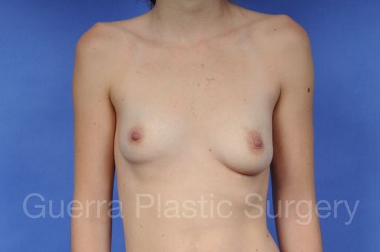 Case #1101012 Before