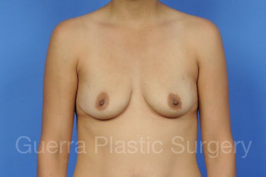 Case #1103001 Before