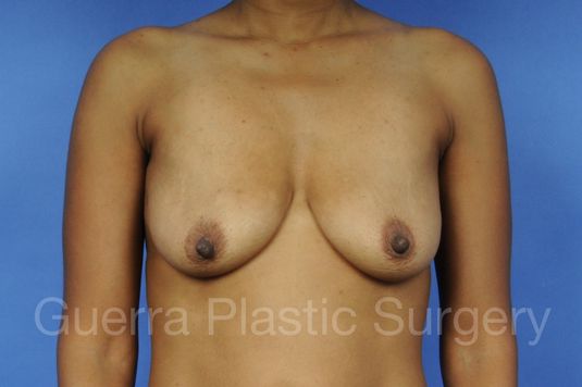 Case #1109004 Before