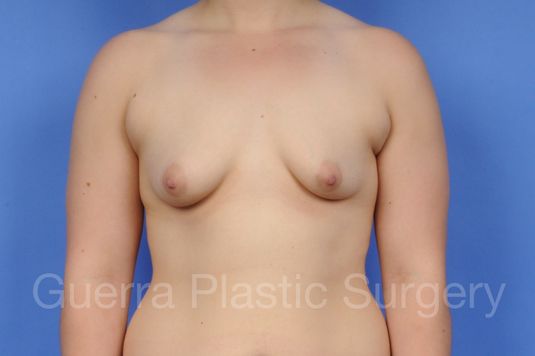 Before and After Breast Lift - Case #1109005 before