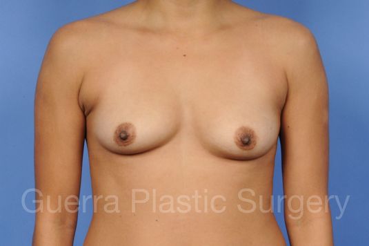 Before and After Breast Lift - Case #1113001 before