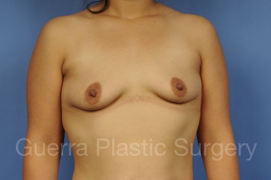 Case #1101016 Before