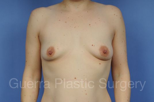 Case #1102001 Before