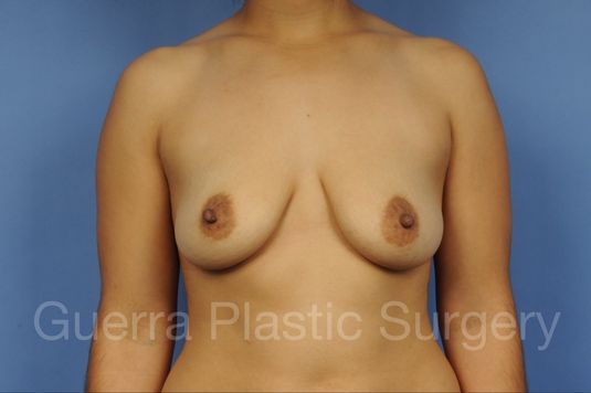 Before and After Breast Lift - Case #1103013 before