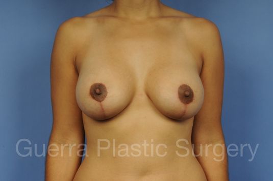 Before and After Breast Lift - Case #1103013 after