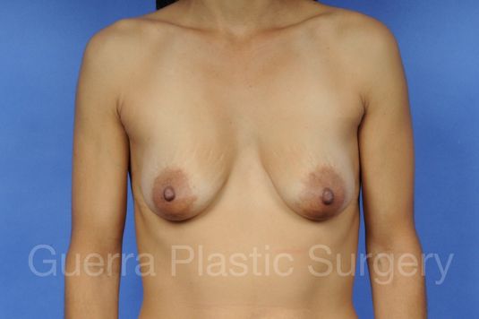 Before and After Breast Lift - Case #1107001 before