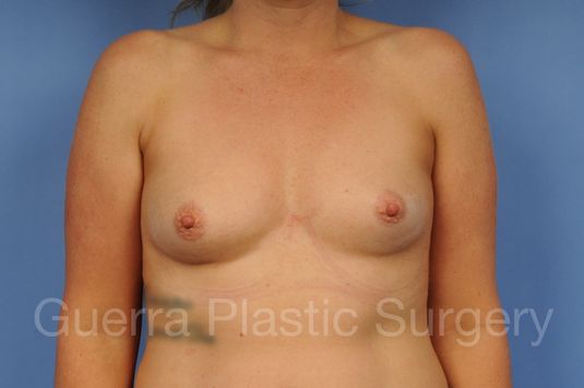 Case #1109012 Before