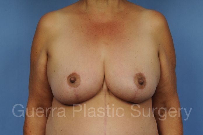Breast Lift / Implant Case #1112005 - after