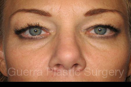 Before Photo Eyelid Surgery