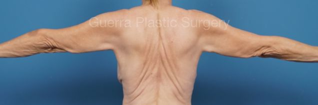 Before Photo Arm Lift