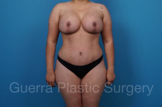 next Case #35814 After