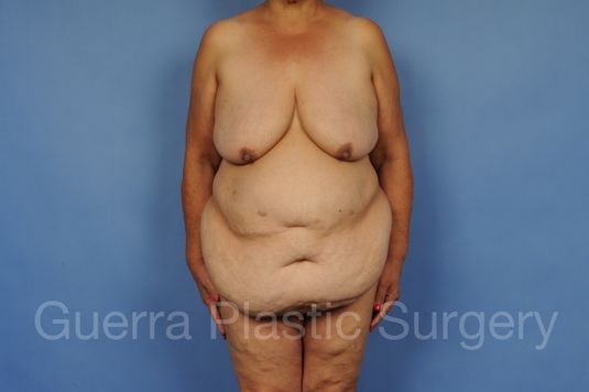 next Case #28080 Before