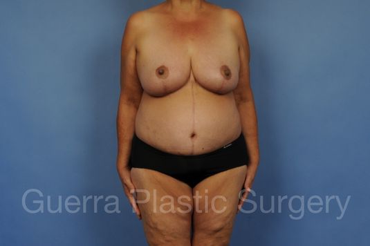 next Case #28080 After