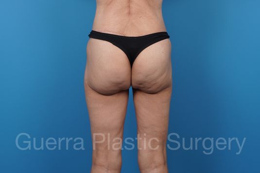 After Photo Spiral Thigh Lift