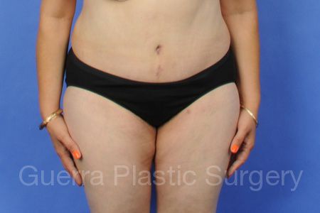 prev Case #5284 After