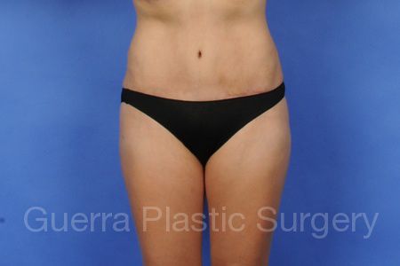 next Case #4047 After