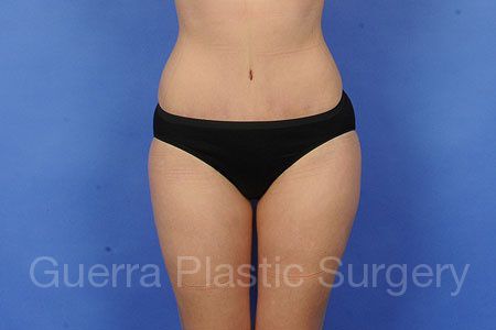 prev Case #7208 After