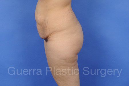 Mommy Makeover Case #6378 - before