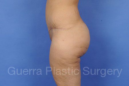 Mommy Makeover Case #6378 - after