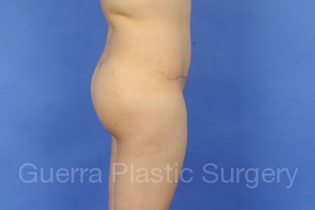 Mommy Makeover Case #5265 - After