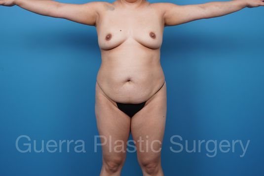 Before Photo Liposuction