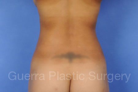 After Photo Liposuction