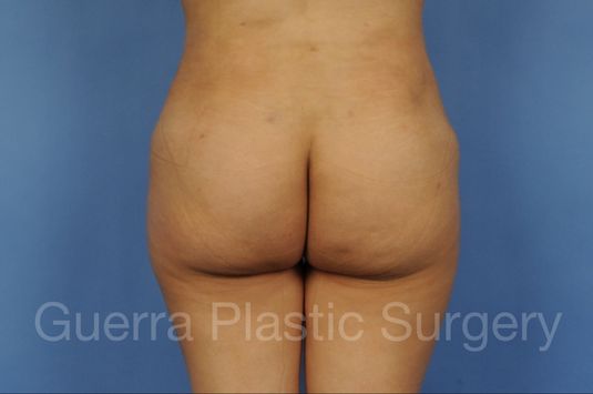 After Photo Brazilian Butt Lift