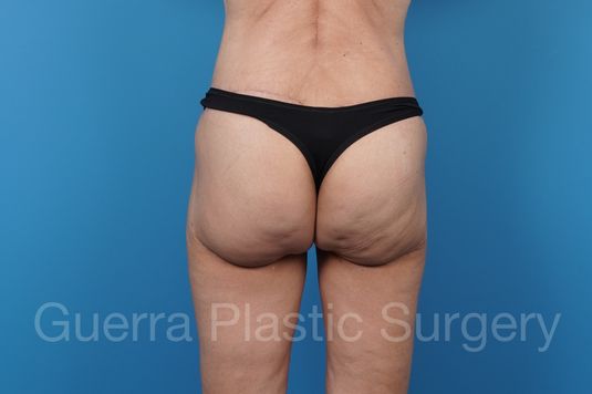 After Photo Brazilian Butt Lift
