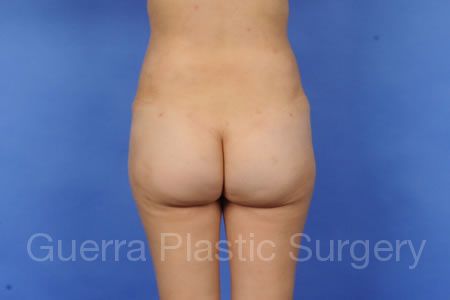 After Photo Brazilian Butt Lift