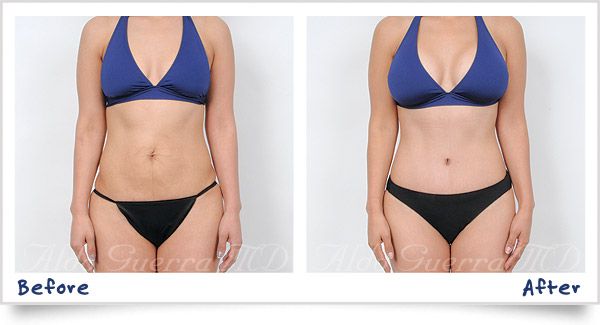 before and after photo of actual mommy makeover patient