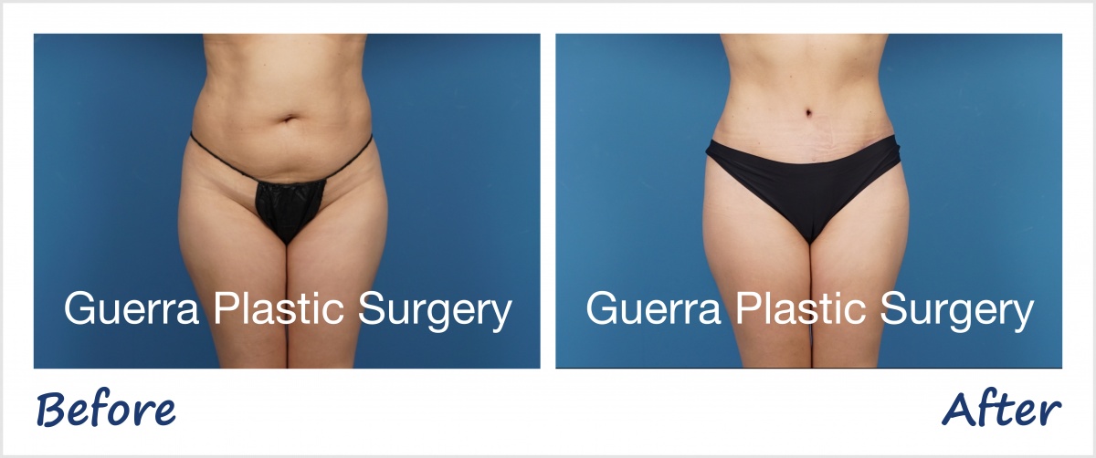 tummy tuck before and after photo