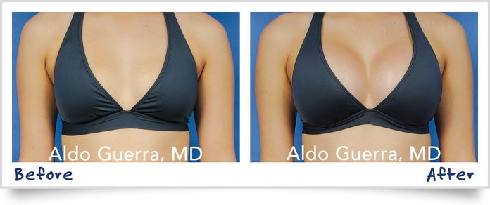 Breast Augmentation photo before and after