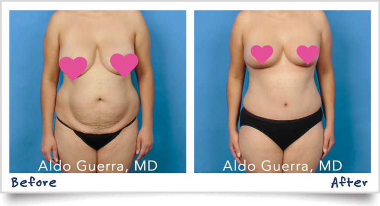 Actual Patient - Tummy Tuck before and after photo