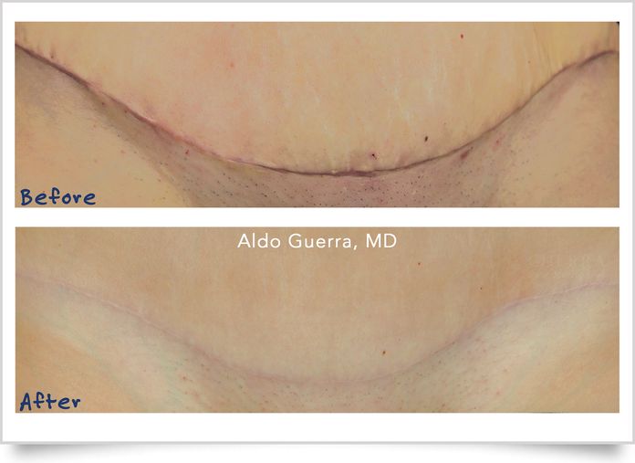 before and after tummy tuck treated with embrace®